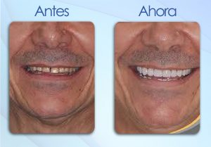 antes y despues 6