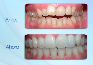 antes-y-despues-8