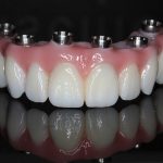 protesis-sobre-implantes